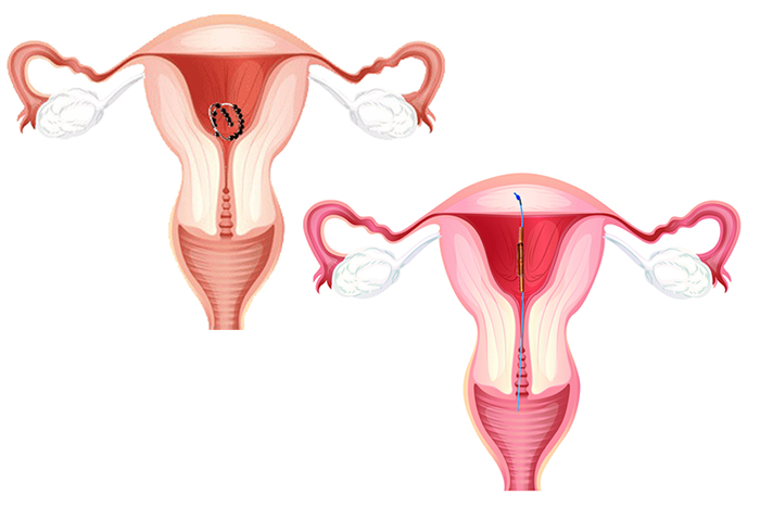 Sex beim kann spirale verrutschen die Verhütung: Hormonspirale